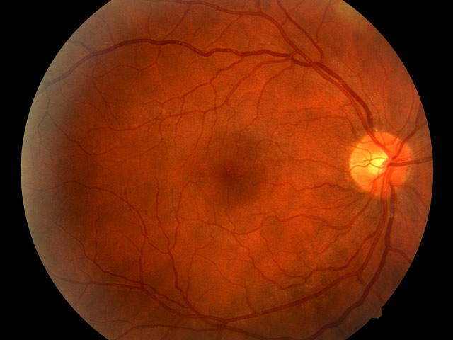 About Diabetic Retinopathy (Retina) - Dr. Navalkar